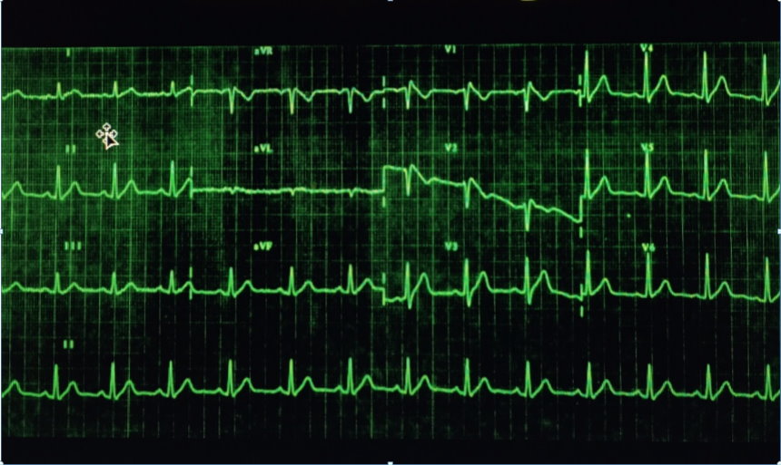 Figura 1 Electrocardiograma de un paciente de 27 años con elevación del punto J en V1V2 y del segmento ST de convexidad superior, con onda T negativa